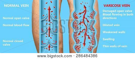 Varicose Veins On A Female Senior Legs. The Structure Of Normal And Varicose Veins. Concept Of Dry S