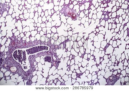 Histopathology Of Pneumonia, Light Micrograph, Photo Under Microscope