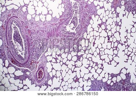 Histopathology Of Pneumonia, Light Micrograph, Photo Under Microscope