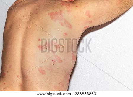 Allergy. Intolerance. Reaction. Histamine. Health
