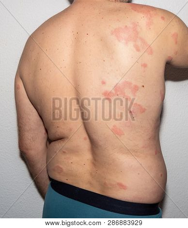 Health. Allergy. Reaction. Histamine. Intolerance