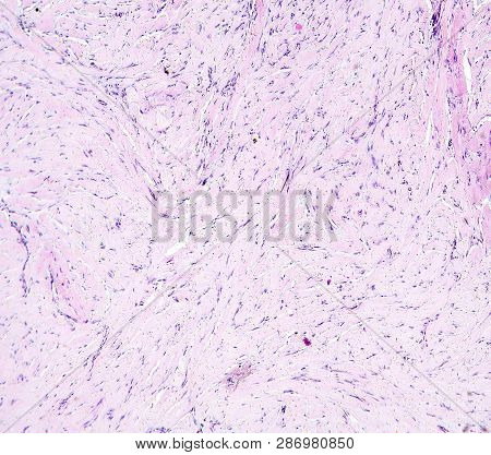 Histology Of Human Tissue, Show Connective Tissue, Hyaline Degeneration Of Spleen As Seen Under The 