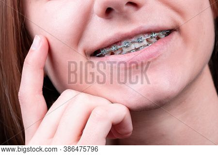 Happy Smile Of Young Woman With Dental Braces