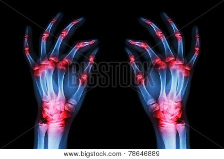 Multiple Joint Arthritis Both Adult Hands ( Gout , Rheumatoid ) On Black Background