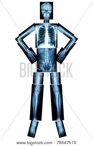 Human Bone Stand And Akimbo ( X-ray Whole Body )