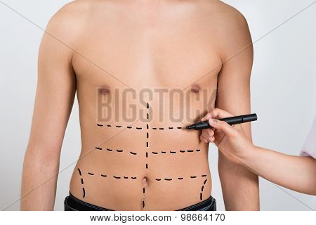 Person Hands Drawing Correction Lines On Abdomen