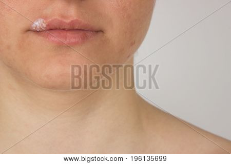 Herpes sore with pus on the lips of a young girl and pimples on the face a cream for healing on a finger
