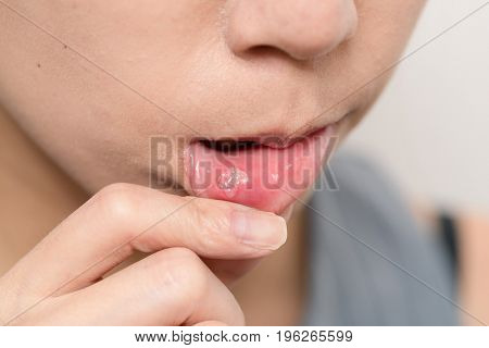 Close up of woman with aphtha