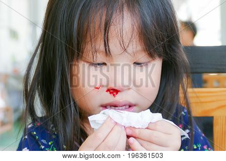 Little Asian Girl Wipe Her Bleeding Nose By Tissue Paper