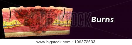 Damage to the skin or deeper tissues caused by sun, hot liquids, fire, electricity or chemicals.