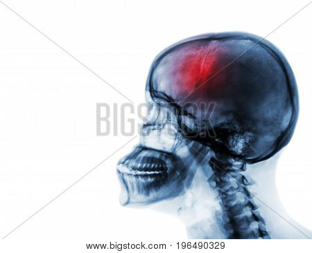 Stroke . Cerebrovascular accident . Film x-ray of human skull and cervical spine . blank area at left side .