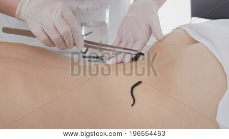 Doctor doing procedure of hirudotherapy for blonde young woman. Tibetan Medicine