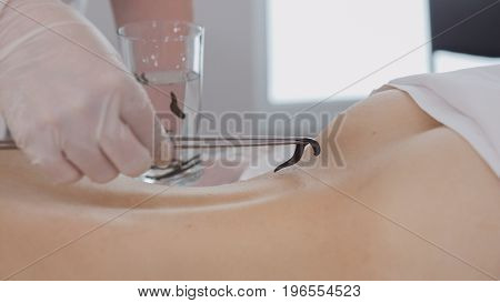 Close up view of hirudotherapy for blonde young woman. Tibetan Medicine