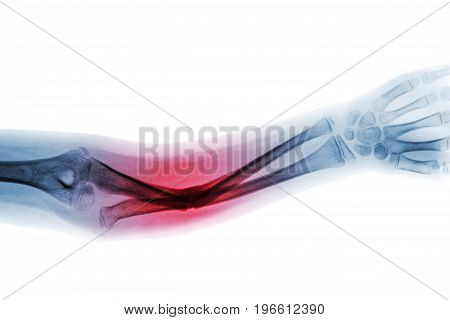 Film x-ray forearm AP show fracture shaft of ulnar bone .