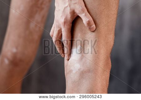 Vitiligo Close-up On The Legs Of A Man. A Young Guy Cares For The Skin, Smears The Skin With Pigment