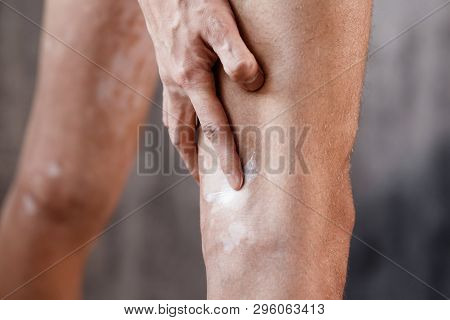 Vitiligo Close-up On The Legs Of A Man. A Young Guy Cares For The Skin, Smears The Skin With Pigment