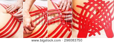Treatment of skin laxity using kinesiology taping. Collage with the process of applying.