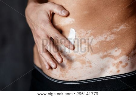 Vitiligo Close-up On The Hands And Elbows Of A Man. A Young Guy Cares For The Skin, Smears The Skin 