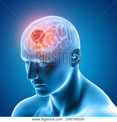 3D render of a medical image showing male figure with brain tumour