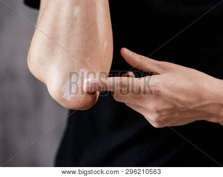 Vitiligo Close-up On The Hands And Elbows Of A Man
