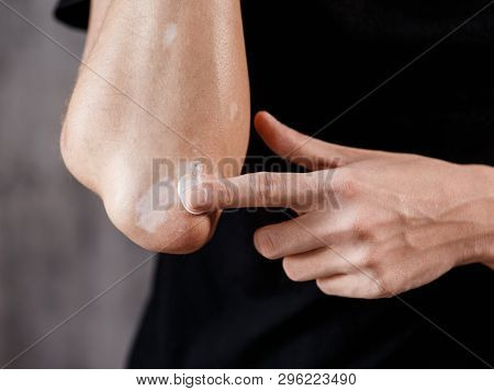 Vitiligo Close-up On The Hands And Elbows Of A Man