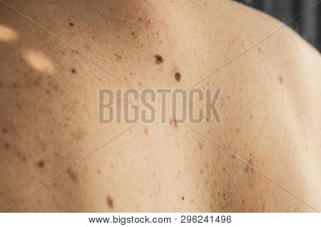 Close Up Detail Of The Bare Skin On A Man Back With Scattered Moles And Freckles. Checking Benign Mo