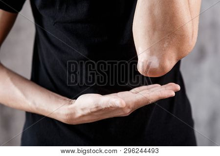 Vitiligo Close-up On The Hands And Elbows Of A Man