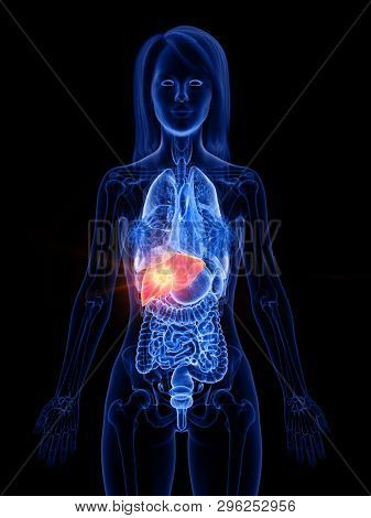 3d rendered medically accurate illustration of a womans liver tumor