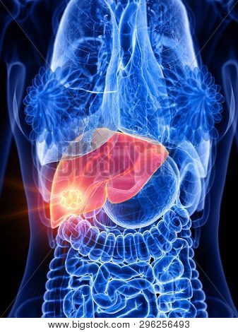 3d rendered medically accurate illustration of a womans liver tumor