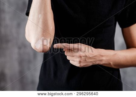 Vitiligo Close-up On The Hands And Elbows Of A Man