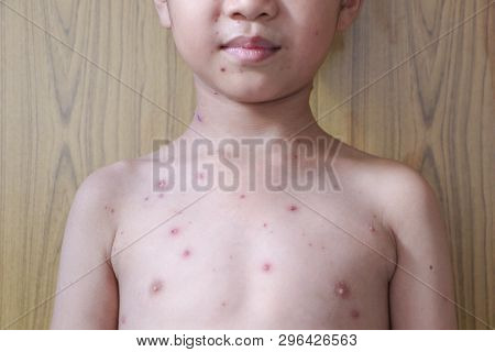 Chicken Pox Rash On Young Boy Body.chickenpox Is An Infection Caused By The Varicella Zoster Virus. 