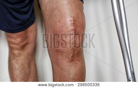Man On Crutches After Knee Replacement Surgery, Stitches Close Up.