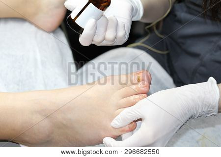 Toenails After Removing Gel Polish. Ugly Toenails. The Cosmetologist Restores The Toenails. Toenail 
