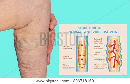Varicose Veins On A Female Senior Legs. The Structure Of Normal And Varicose Veins. Concept Of Dry S