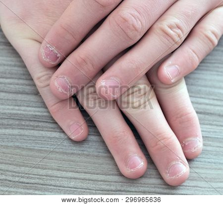 The Hands Of Teenager With Burrs On The Fingernail. Nibbles Fingernail