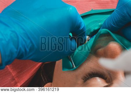 Installation Of A Cofferdam To The Patient, Modern Dental Equipment, Treatment In Sterile Conditions