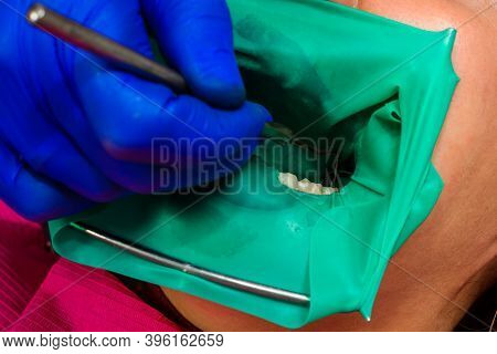 The Dentist Treats The Patients Tooth With A Rubber Dam, Drill, Mirror.