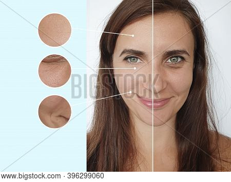 Woman Face Wrinkles Before And After Treatment