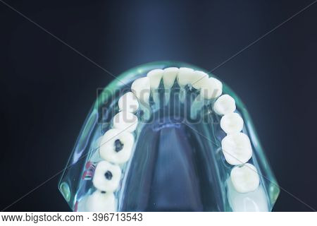 Tooth Decay Dental Model