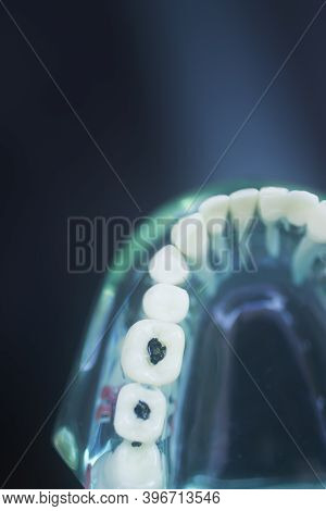 Tooth Decay Dental Model