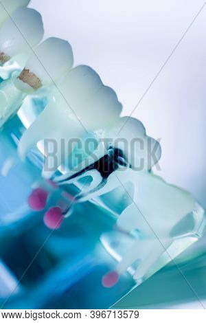 Tooth Decay Dental Model
