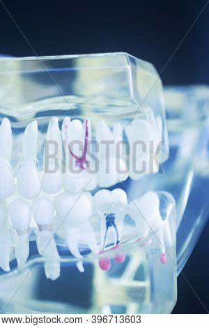 Tooth Decay Dental Model