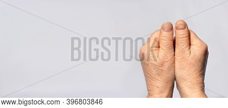 Nail Fungus On The Hands - Dermatomicosis And Onyhomicosis, Comparison Of Healthy And Sick Nails. De