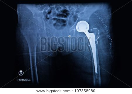 X-ray Of The Hip Endoprosthesis In Elderly Woman, Total Hip Replacement
