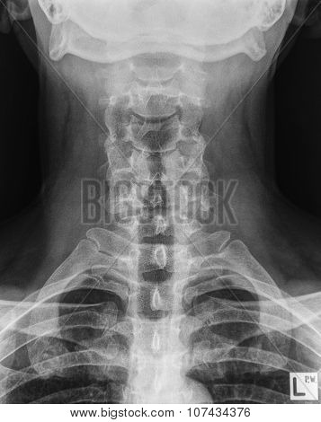 Neck X-ray