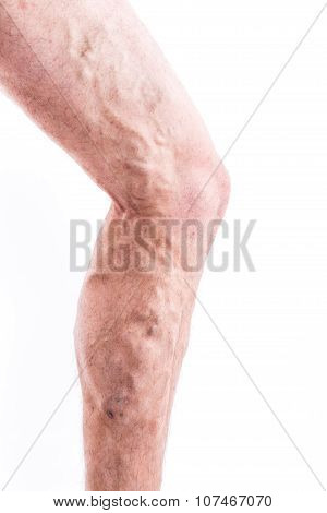 People With Varicose Veins Of The Lower Extremities And Venous Thrombophlebitis And Standing On A Wh