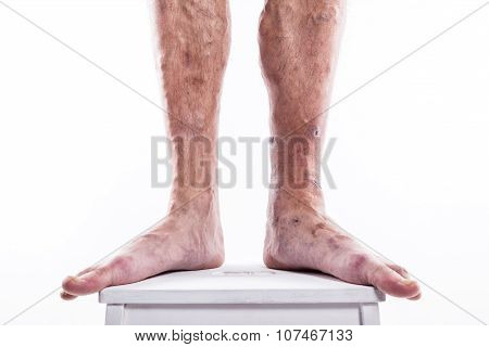 People With Varicose Veins Of The Lower Extremities And Venous Thrombophlebitis And Standing On A Wh
