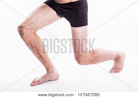 People With Varicose Veins Of The Lower Extremities And Venous Thrombophlebitis And Standing On A Wh