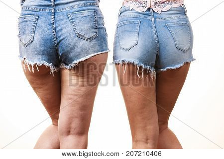 Comparison of female legs thighs with and without cellulite. Skin problem body care overweight and dieting concept.