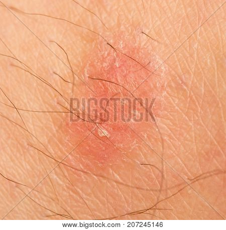 Ringworm on human skin . Photo of abstract background